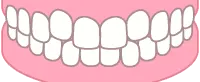 軽度叢生イラスト