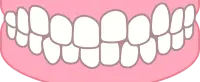 軽度上顎前突イラスト
