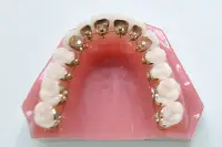 舌側矯正