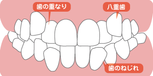 叢生イラスト