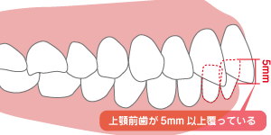 過蓋咬合イラスト