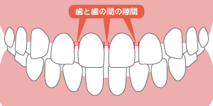 空隙歯列イラスト