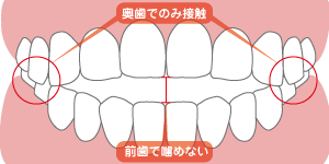 開咬イラスト