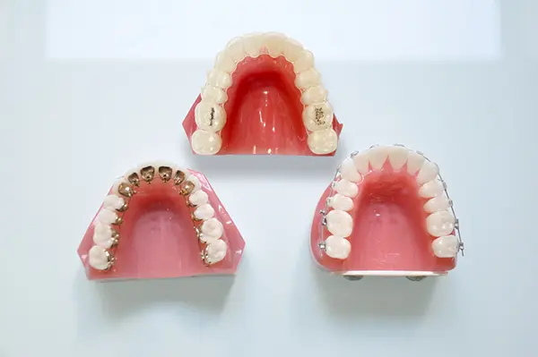 様々な矯正装置の模型