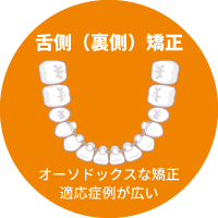 マウスピース矯正